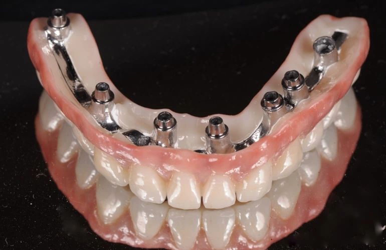 wykonywanie implantów zębów 